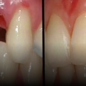 Zbulohet teknika që rrit dhëmbin e rënë në vetëm 10 javë!